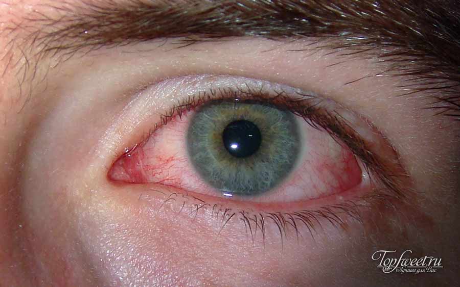 Токсоплазмоз глаз